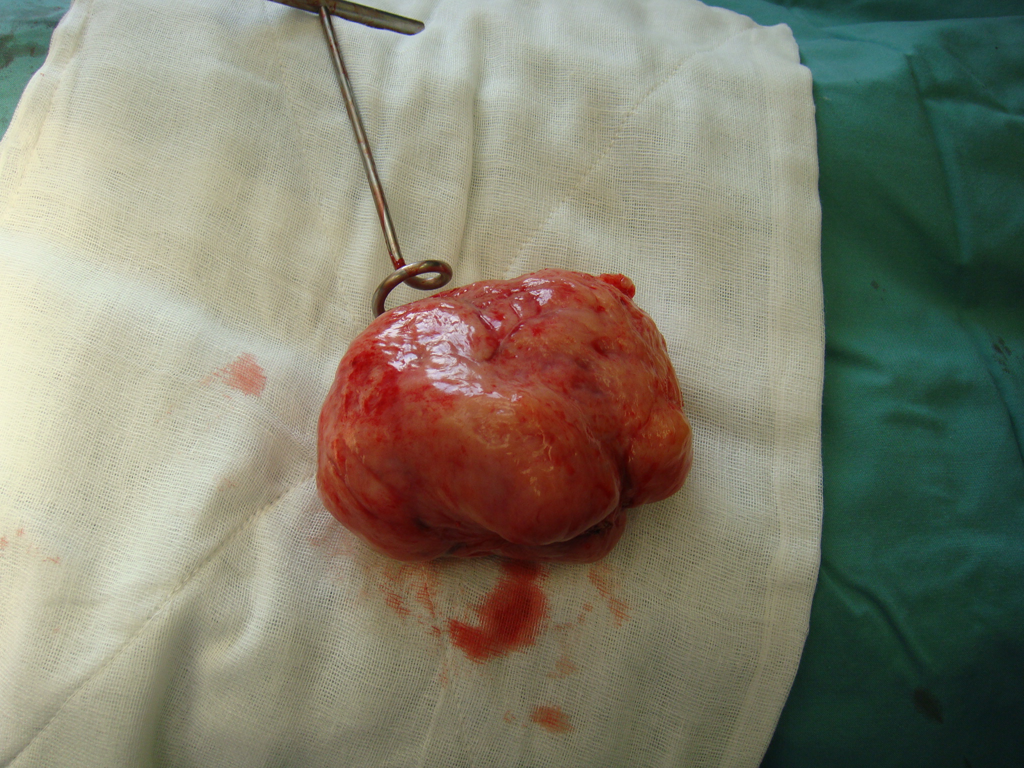 Fibroid Myomectomy